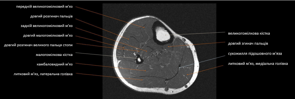 МРТ м’яз гомілки