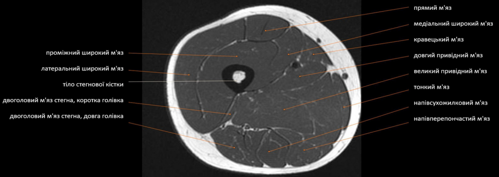 МРТ м’яз стегна